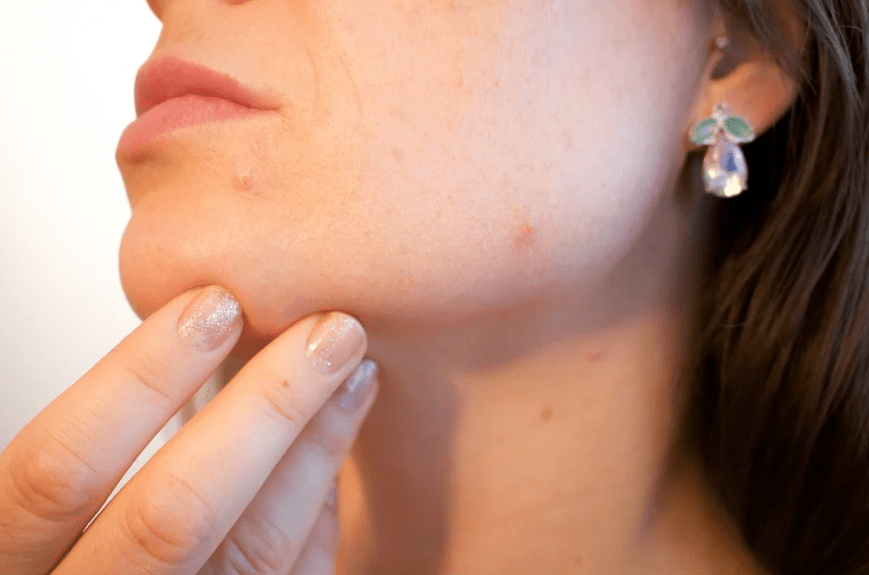 acne on a female’s face